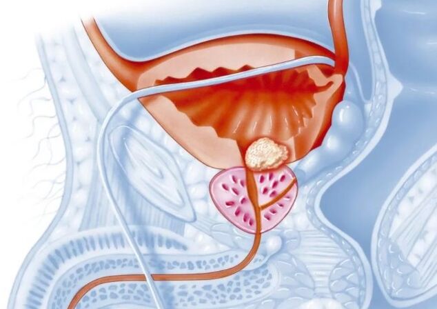 Características de la forma crónica de prostatitis