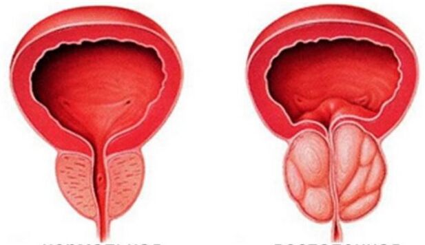 Prostatitis crónica