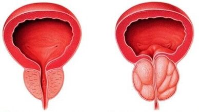 Prostata sana e inflamada con prostatitis