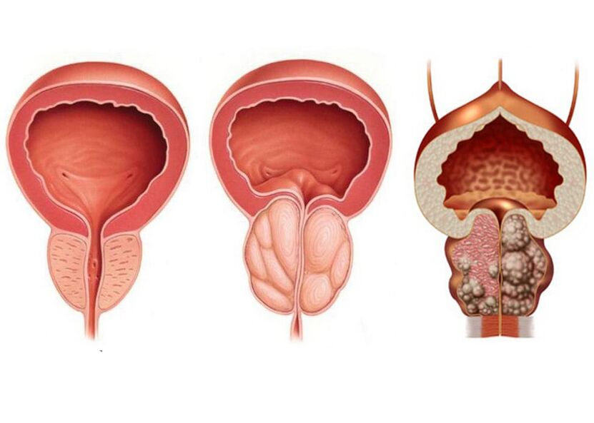 etapas de la prostatitis y la necesidad de tratamiento con Prostavit